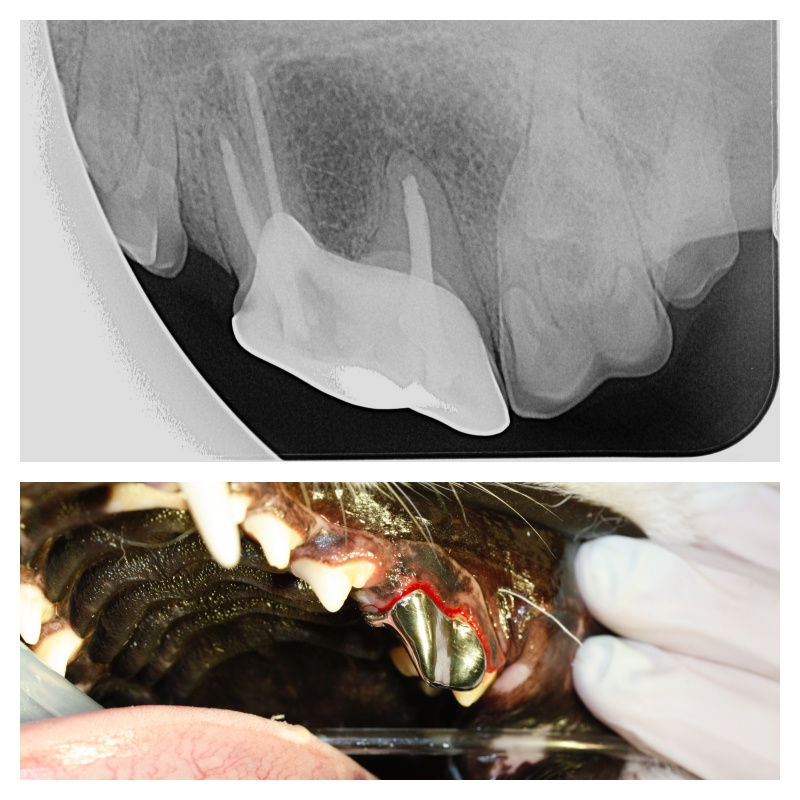 post root canal and crown - Fractured Teeth